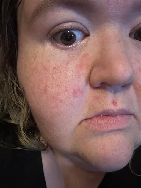 Rash appearing on cheeks and upper lip. Doesn’t itch or hurt. But peels and won’t go away. : r ...