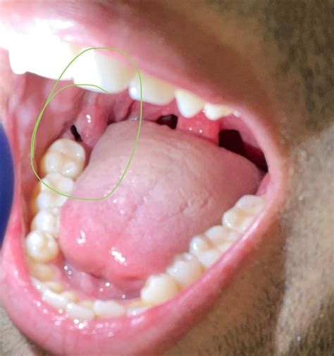 Coffee Dry Socket at Jonathan Landseer blog