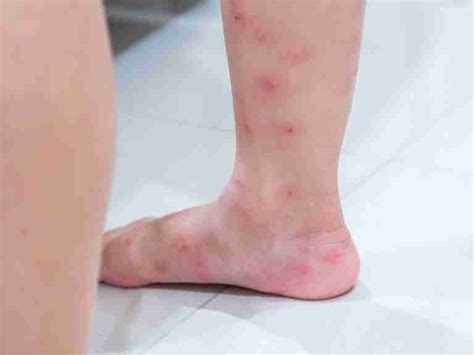 The Effects Of A Green Ant Bite: Symptoms And Treatment