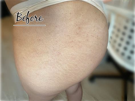 How to get rid of hyperpigmentation on buttocks – Artofit