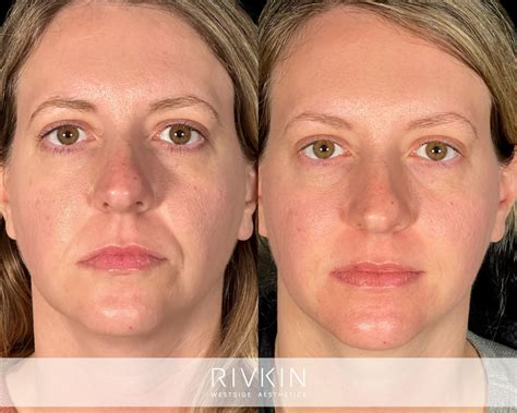 Nasolabial Folds - RIVKIN Aesthetics