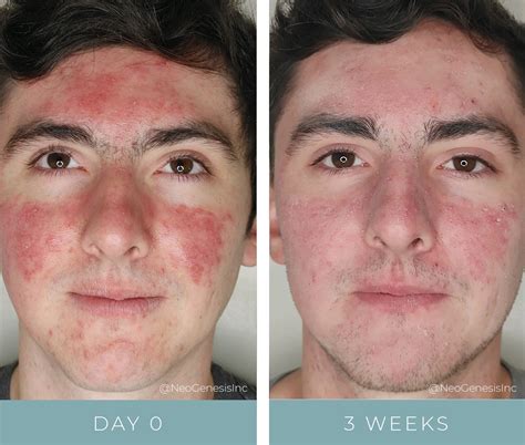 What To Do After Salicylic Acid Burn at Ella Hogarth blog