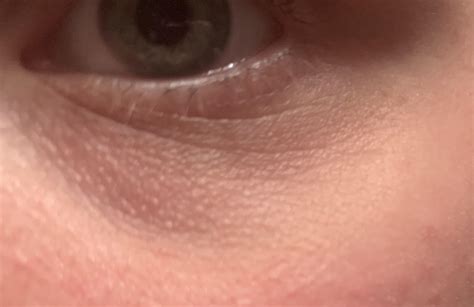 Advice on how to get rid of these little bumps under eyes and help dark circles? : r/SkincareAddicts