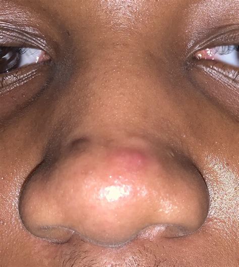 Reoccurring Bumps On My Nose? Any diagnosis or treatments? : r/acne