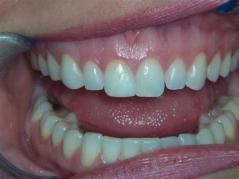 What Is The Purpose Of Canine Teeth In Humans