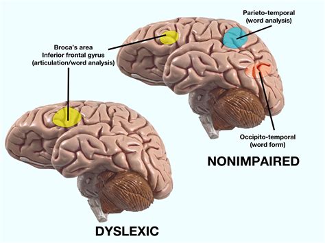 What Does Dyslexia Look Like