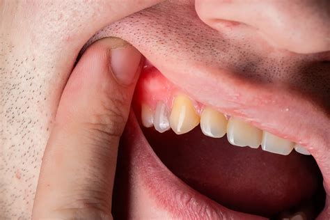 Amoxicillin for Tooth Infection | LifeMD