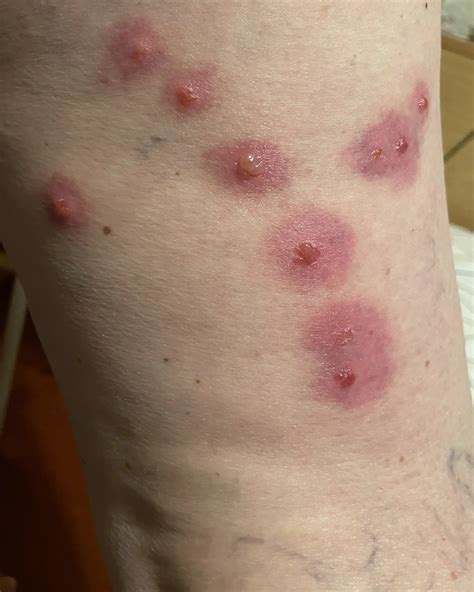 Bed Bugs Rash Treatment