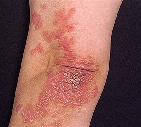 What Does Psoriasis Look Like