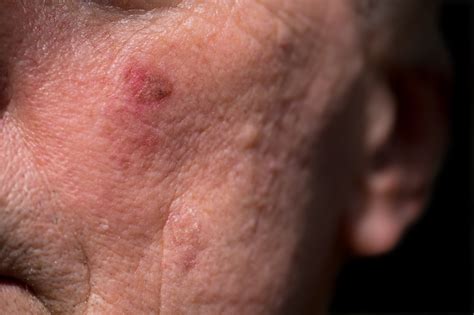 Actinic Keratoses Treatment – Chatham Skin Clinic