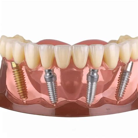 What Are the 3 Best Materials for Dental Implants?