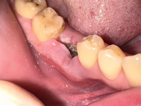 Gum Infection After Tooth Extraction Tooth Extraction In Port