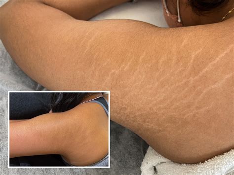 How To Get Rid Of Stretch Marks On Legs Eliminating Stretch Marks With