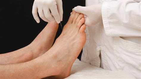 Dry Needling Vs Acupuncture | The Feet People Podiatry