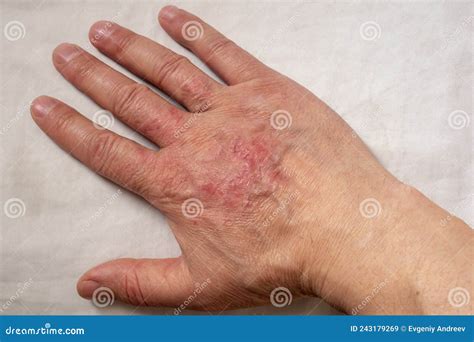 What Is A Thermal Burn at Shirley Gonzalez blog