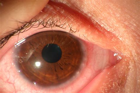 How Is Vernal Keratoconjunctivitis Treatment at Patrick Mckinnon blog