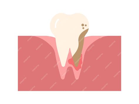 Premium Vector | Periodontitis gingivitis vector illustration. tooth with inflammation vector ...