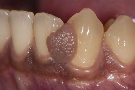 Tongue Bumps: Photos, Potential Causes, Symptoms, and Treatment