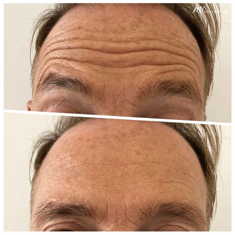Anti-wrinkle treatments with muscle relaxants from £99 | M1 Med Beauty