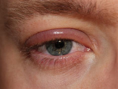 Eye Orbital Cellulitis