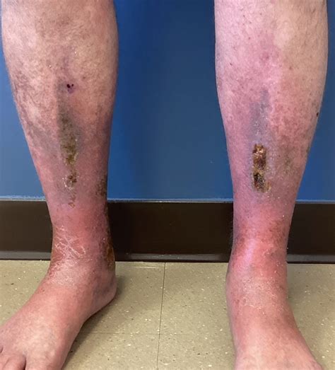 Management Of Stasis Dermatitis