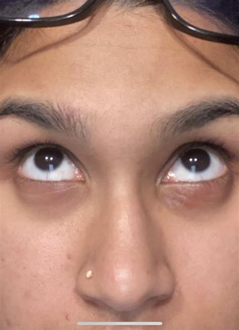 i’ve had this off and on hive likes rash under my eyes : r/Perioral_Dermatitis_
