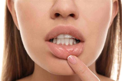 How to Get Rid of Sores in Mouth | Mouth Sore Remedies