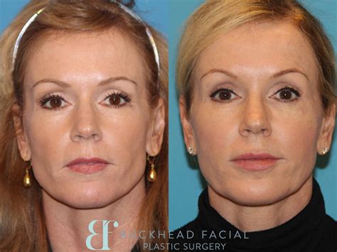 Sculptra® Case #118