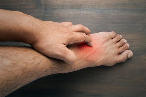 Burning Feet - Causes, Diagnosis, and Treatment