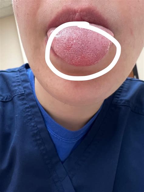 HELP-inflamed taste buds and red patch?? : r/askadentist