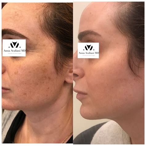 PicoSure: The Dark Spot Removal Treatment For All Skin Types - Anna Avaliani MD - Cosmetic ...