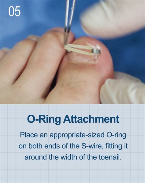 Onycho Clip - TERASYS (Domestic)