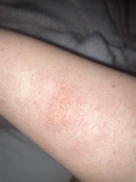 Weird bump. Looked like a mozzie bite at first, but wasn't itchy and ...