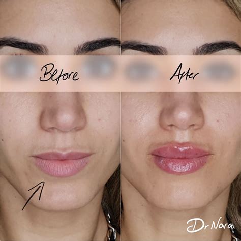 1ml lip filler 👄 Treatment time is around 20... | Dr Nora
