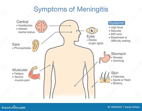 Diagram To Showing Patient Symptoms with Meningitis Disease. Stock Vector - Illustration of ...