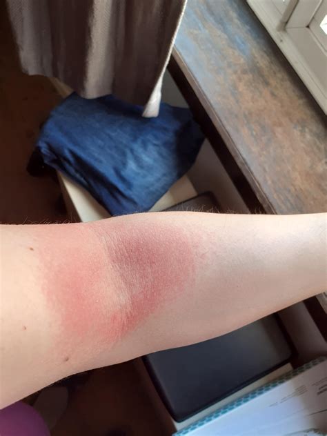 Rash in both inner elbows after sweating a lot : r/DiagnoseMe