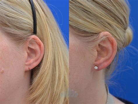 Earlobe Repair Before and After Pictures Case 79 | Charlotte, NC | Dilworth Facial Plastic Surgery