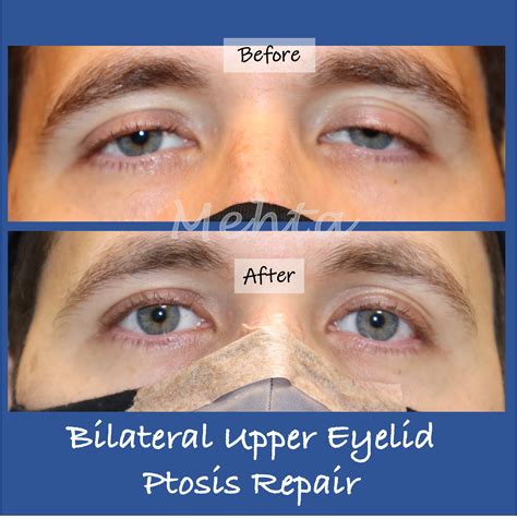 Sagging Eyelids Treatment