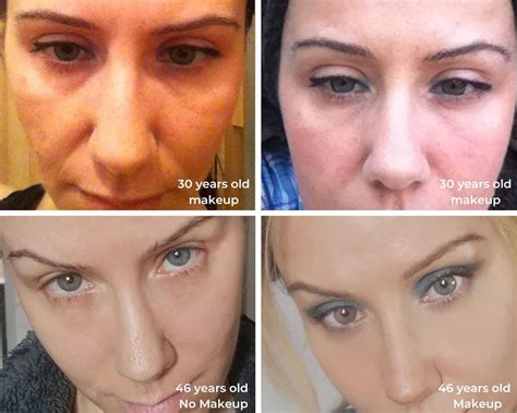 TCA Peel At Home: How I did It Safely + Before & After Photos!