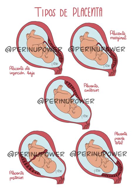Placenta Posterior Grau 1 - RETOEDU