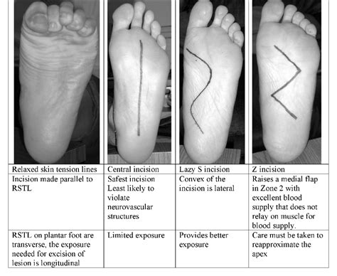 [PDF] PLANTAR FIBROMATOSIS : Treatment Considerations | Semantic Scholar