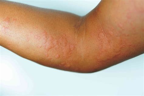 Hives vs. Rash: Symptoms, Causes, Treatment