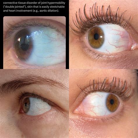 blue sclera? : r/eds