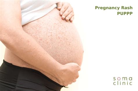 PUPPP Rash: 7 Little-known Ways To Sooth Your Pregnancy Rash, No Steroids