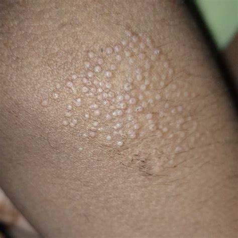my kid has this type of pimples on his elbow,knees, fingers etc what to do ? treatment for this ...