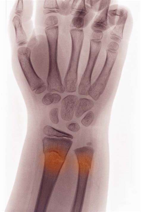Buckle Fracture: Symptoms, Causes, and Treatment