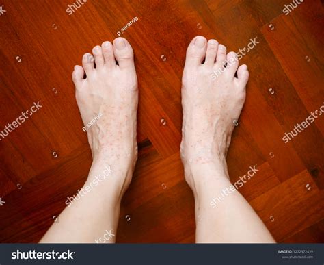 Itchy Rash On Feet at Shannon London blog