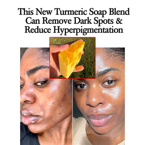 Turmeric Soap Benefits: 10 Life Changing Benefits Of Turmeric Bar Soap ...
