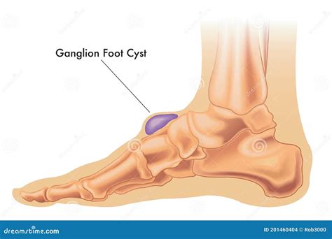 Ganglion Cyst On Foot Vector Illustration | CartoonDealer.com #201460404