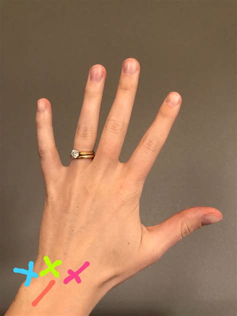 Wrist Pain Pinky Side Swelling at Ricardo Watkins blog